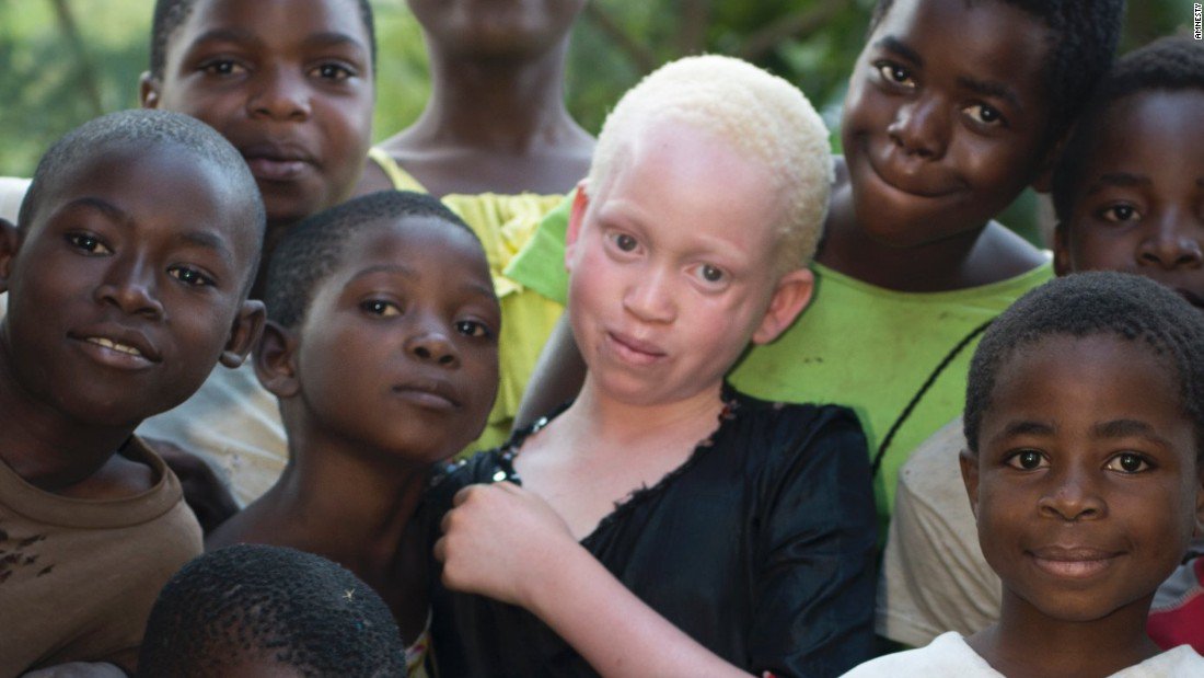 Malawi’s weak criminal justice system fails people with albinism