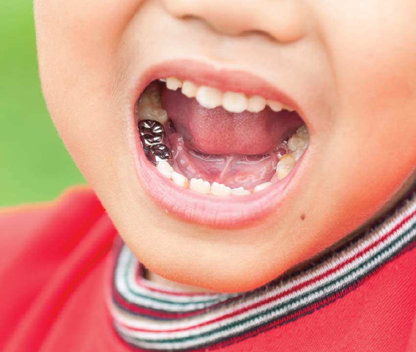 How Does a Stainless Steel Crown Save a Baby Tooth?